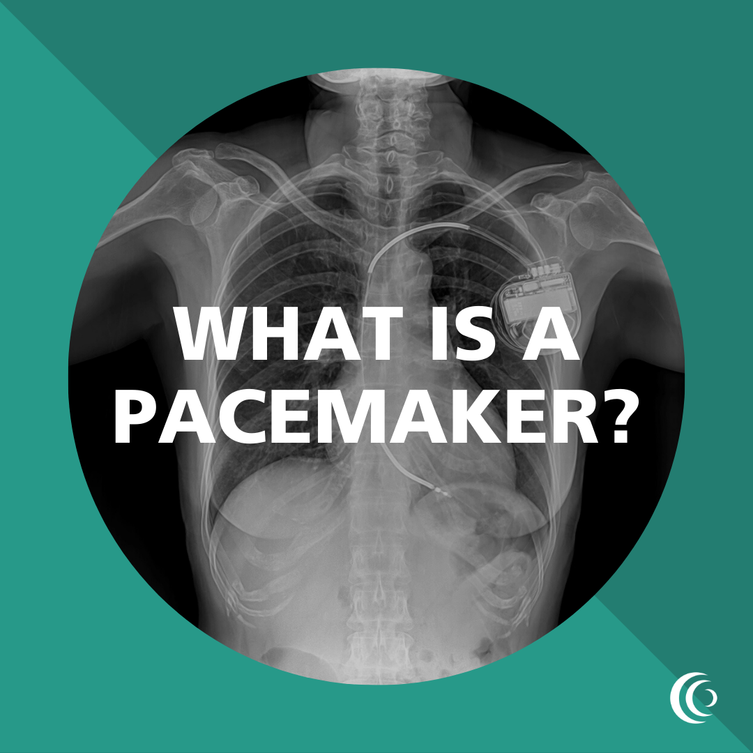 What Is A Pacemaker 